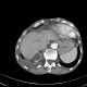 Carcinoma of adrenal gland, adrenal carcinoma: CT - Computed tomography